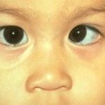 Amblyopia: a child with strabismic exotropia, a common underlying cause of amblyopia