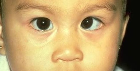 Amblyopia: Why the Brain, Not the Eye, Is the Real Target