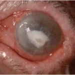 Amniotic membrane transplantation: a large corneal epithelial defect and stromal opacity before treatment