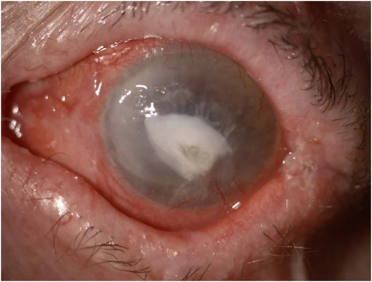 Amniotic Membrane Transplantation: A Biological Scaffold for Healing