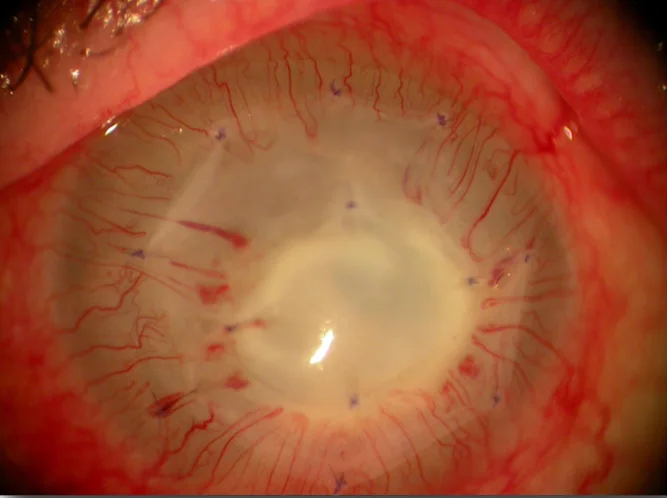 Amniotic membrane transplantation: an amniotic membrane graft secured over the ocular surface with interrupted sutures