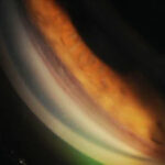 Clinical eye photograph illustrating Angle Recession Glaucoma Trauma