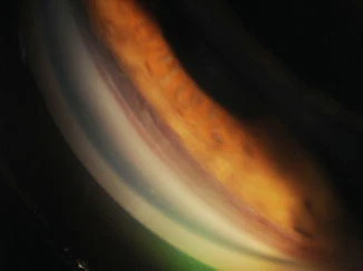 Angle Recession Glaucoma: The Delayed Consequence of Blunt Eye Trauma