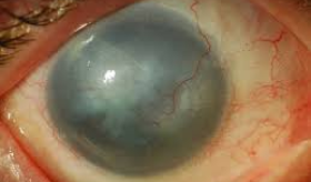 Aniridia-related keratopathy: progressive central corneal clouding