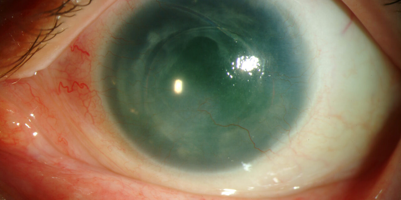 Aniridia-Related Keratopathy: The Complication That Outlasts the Iris