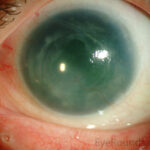 Aniridia-related keratopathy: diffuse corneal haze and superficial vascularization