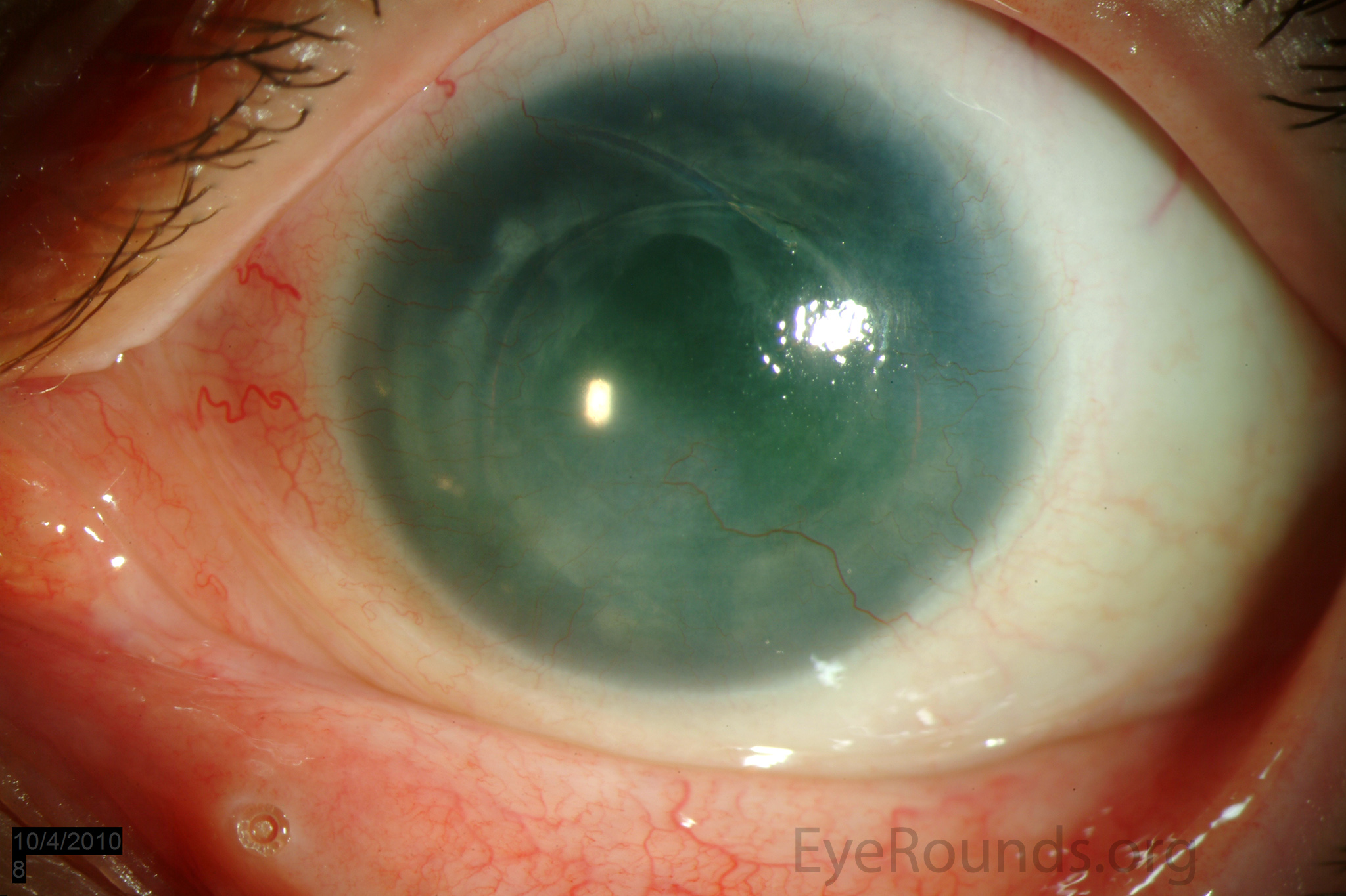Aniridia-related keratopathy: diffuse corneal haze and superficial vascularization