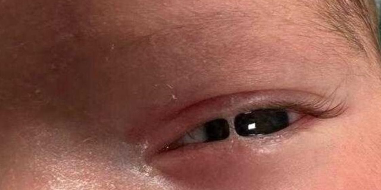 Ankyloblepharon: When the Eyelids Fuse Together