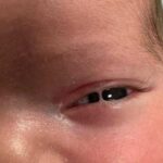 Ankyloblepharon filiforme adnatum: a thin band of tissue fusing the upper and lower eyelids in a newborn