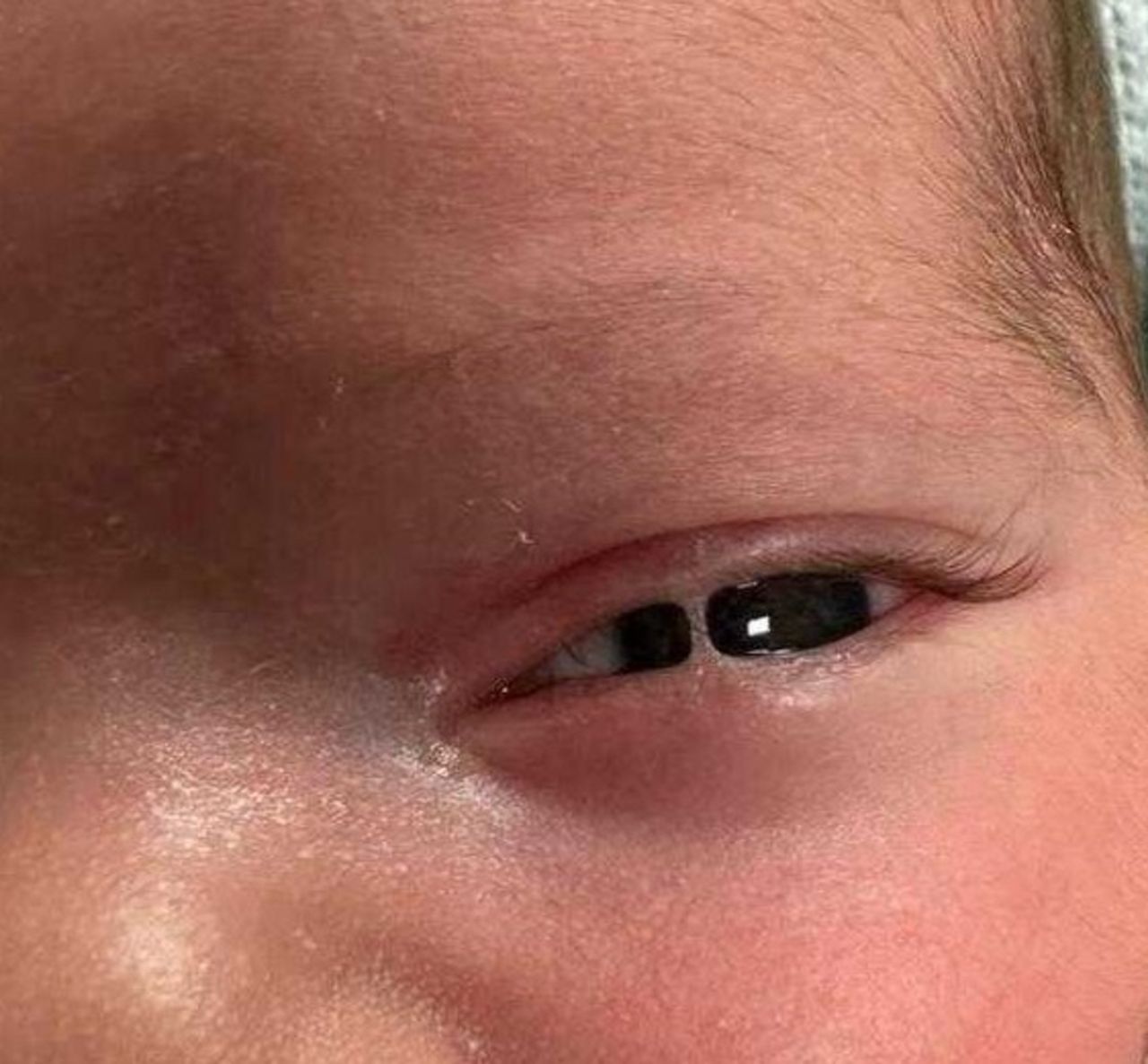 Ankyloblepharon Filiforme Adnatum Newborn Ankyloblepharon filiforme adnatum: a thin band of tissue fusing the upper and lower eyelids in a newborn