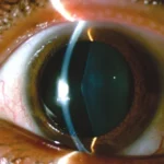 Clinical eye photograph illustrating Anterior Lenticonus Alport Syndrome