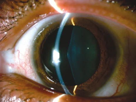 Anterior Lenticonus: The Lens Sign That Points to Alport Syndrome