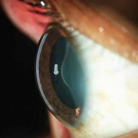 Clinical eye photograph illustrating Anterior Lenticonus Alport Syndrome