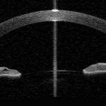 Anterior segment OCT: cross-sectional image showing the corneal profile and anterior chamber angle