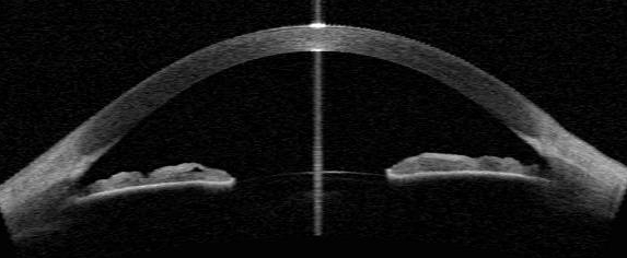 Anterior Segment OCT: Seeing the Angle and Cornea Without Touching the Eye