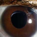 Aphakic glaucoma: an aphakic eye with a peripheral iridectomy after pediatric cataract surgery