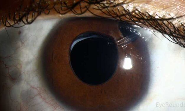 Aphakic Glaucoma: A Risk That Lasts Decades After Pediatric Cataract Surgery
