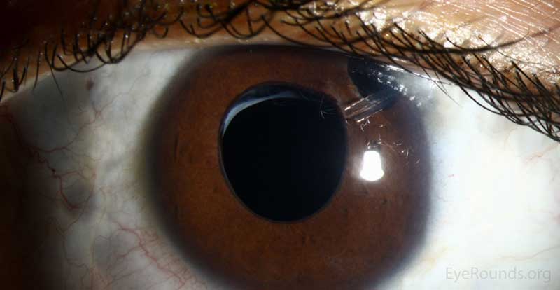 Aphakic Glaucoma: A Risk That Lasts Decades After Pediatric Cataract Surgery