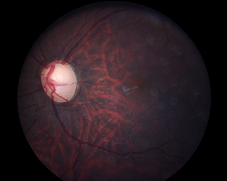Aphakic glaucoma: fundus photograph showing a pale, glaucomatous optic disc