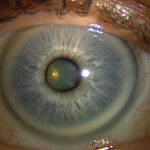Clinical eye photograph illustrating Arcus Juvenilis Lipid Metabolism