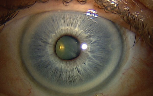Arcus Juvenilis: When a Lipid Ring Appears Too Early to Ignore