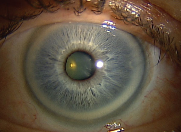 Arcus Juvenilis: When a Lipid Ring Appears Too Early to Ignore