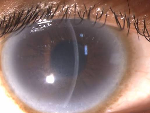 Clinical eye photograph illustrating Arcus Juvenilis Lipid Metabolism