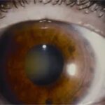 Argon laser peripheral iridoplasty: peripheral iris after treatment, showing scattered laser burn marks