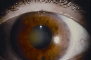 Argon Laser Peripheral Iridoplasty Treated Iris Argon laser peripheral iridoplasty: peripheral iris after treatment, showing scattered laser burn marks