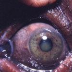 Argyria: bluish-gray discoloration of the iris and conjunctiva from silver deposition