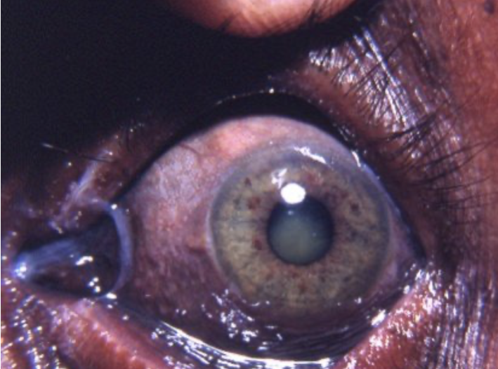 Argyria: The Permanent Gray Eye From Colloidal Silver