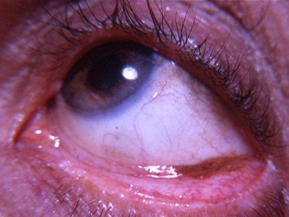 Argyria: slate-gray pigmentation along the inferior palpebral conjunctiva
