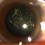 Clinical eye photograph illustrating Asteroid Hyalosis Clinical Significance