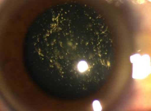 Asteroid Hyalosis: Why This Striking Fundus Finding Rarely Needs Treatment