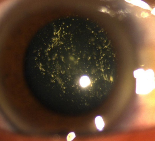 Asteroid Hyalosis: Why This Striking Fundus Finding Rarely Needs Treatment