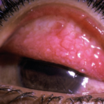 Clinical eye photograph illustrating Atopic Keratoconjunctivitis Shield Ulcer