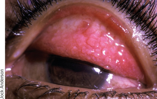 Atopic Keratoconjunctivitis and the Shield Ulcer: A Sight-Threatening Complication of Itching