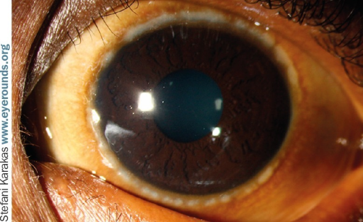 Clinical eye photograph illustrating Atopic Keratoconjunctivitis Shield Ulcer