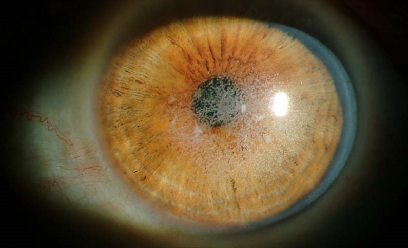Avellino corneal dystrophy: granular-appearing stromal opacities on slit-lamp exam