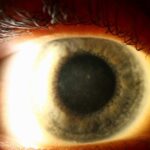 Avellino corneal dystrophy: sclerotic scatter illumination showing discrete white stromal deposits