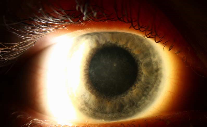 Avellino Corneal Dystrophy: The Refractive Surgery Trap