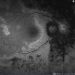 AZOOR: fundus autofluorescence showing a hyperautofluorescent zonal border at the margin of the affected retina