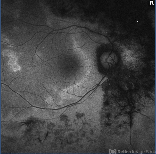 AZOOR: When the Field Is Gone but the Fundus Looks Fine