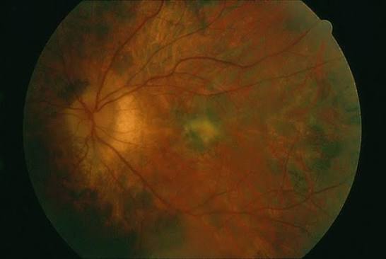 AZOOR: color fundus photograph showing peripapillary retinal pigment epithelial atrophy