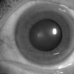 Clinical eye photograph illustrating Band Keratopathy Chelation Treatment