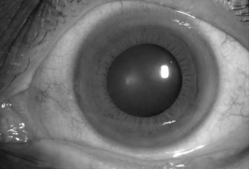 Band Keratopathy: When and How to Chelate the Calcium Away