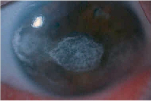 Clinical eye photograph illustrating Band Keratopathy Chelation Treatment