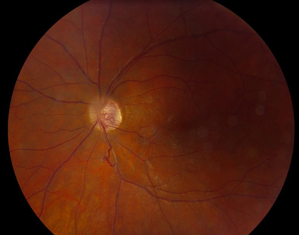 Behçet uveitis: fundus photograph with attenuated retinal vessels and optic disc changes after recurrent retinal vasculitis
