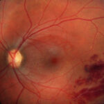 Behçet uveitis: fundus photograph with a pale optic disc and retinal hemorrhages along the inferotemporal vessels