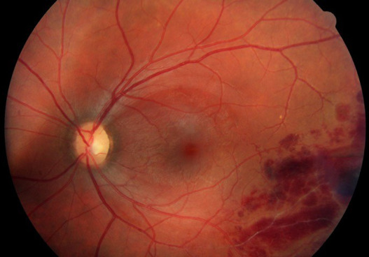 Behçet Uveitis: Occlusive Retinal Vasculitis in a Young Patient With a Quiet Eye